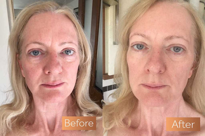 Stunning Collagen Before and After Transformations: What to Expect! - Vitauthority